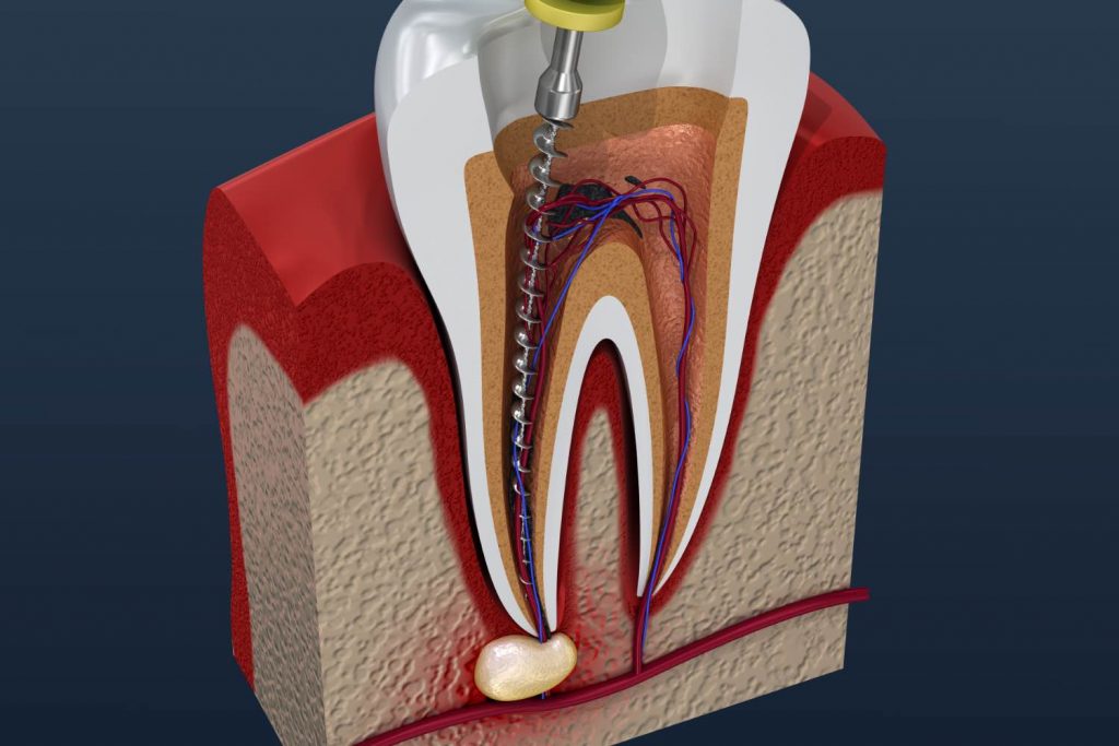 A side view of a tooth cut in half so you can see inside. On one side of the tooth's roots, a long metal tool that re... image