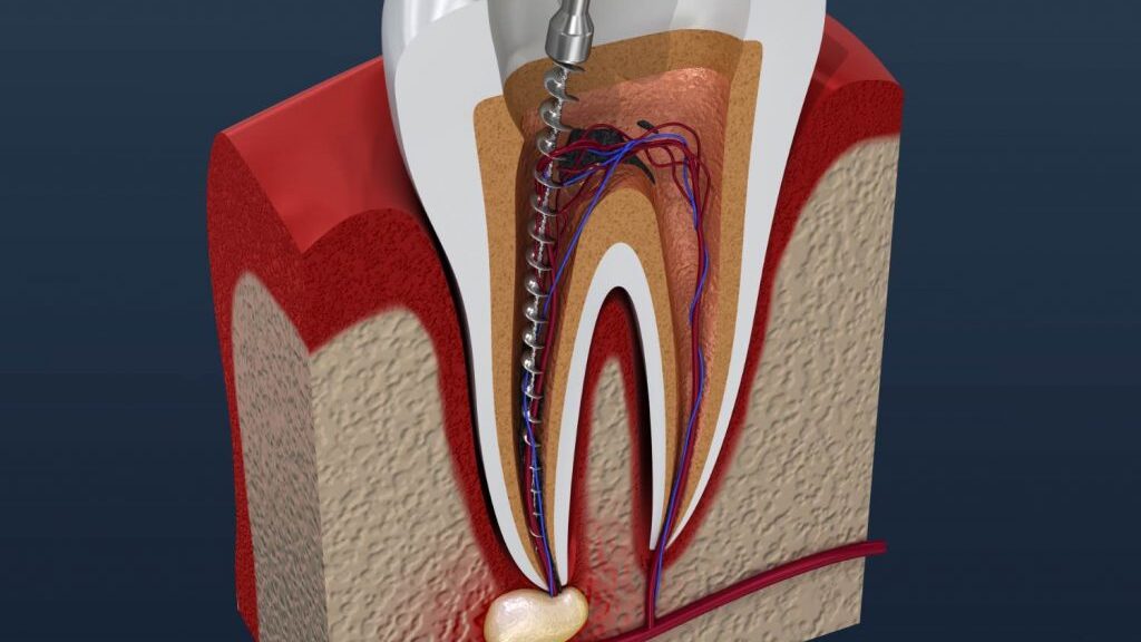 A side view of a tooth cut in half so you can see inside. On one side of the tooth's roots, a long metal tool that re... image